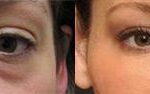 Cosmetic Injectables Before and After Photos in Cincinnati, OH, Patient 5524