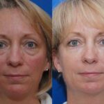 Cosmetic Injectables Before and After Photos in Cincinnati, OH, Patient 5541