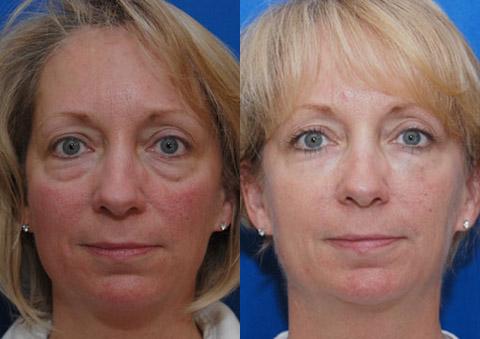 Cosmetic Injectables Before and After Photos in Cincinnati, OH, Patient 5541