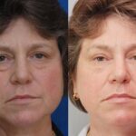 Cosmetic Injectables Before and After Photos in Cincinnati, OH, Patient 5544