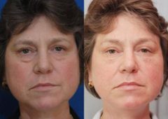 Cosmetic Injectables Before and After Photos in Cincinnati, OH, Patient 5544