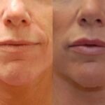 Cosmetic Injectables Before and After Photos in Cincinnati, OH, Patient 5547