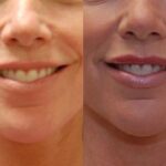Cosmetic Injectables Before and After Photos in Cincinnati, OH, Patient 5547