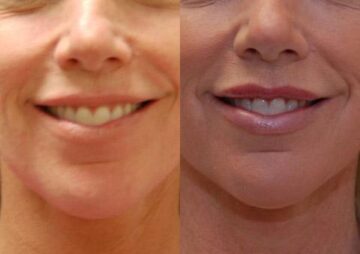 Cosmetic Injectables Before and After Photos in Cincinnati, OH, Patient 5547