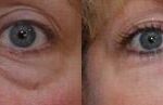 Cosmetic Injectables Before and After Photos in Cincinnati, OH, Patient 5552