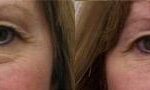 Cosmetic Injectables Before and After Photos in Cincinnati, OH, Patient 5555