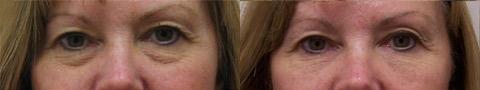Cosmetic Injectables Before and After Photos in Cincinnati, OH, Patient 5555