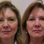 Cosmetic Injectables Before and After Photos in Cincinnati, OH, Patient 5555