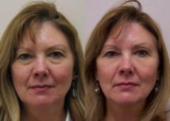 Cosmetic Injectables Before and After Photos in Cincinnati, OH, Patient 5555