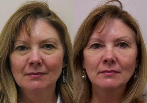 Cosmetic Injectables Before and After Photos in Cincinnati, OH, Patient 5555