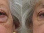 Cosmetic Injectables Before and After Photos in Cincinnati, OH, Patient 5560