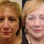 Cosmetic Injectables Before and After Photos in Cincinnati, OH, Patient 5563