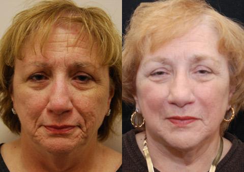 Cosmetic Injectables Before and After Photos in Cincinnati, OH, Patient 5563