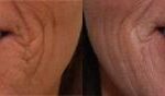 Cosmetic Injectables Before and After Photos in Cincinnati, OH, Patient 5581