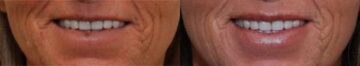 Cosmetic Injectables Before and After Photos in Cincinnati, OH, Patient 5581
