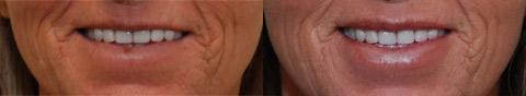 Cosmetic Injectables Before and After Photos in Cincinnati, OH, Patient 5581