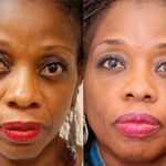 Cosmetic Injectables Before and After Photos in Cincinnati, OH, Patient 5595