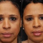 Cosmetic Injectables Before and After Photos in Cincinnati, OH, Patient 5598