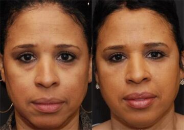 Cosmetic Injectables Before and After Photos in Cincinnati, OH, Patient 5598