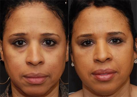 Cosmetic Injectables Before and After Photos in Cincinnati, OH, Patient 5598