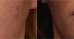 Cosmetic Injectables Before and After Photos in Cincinnati, OH, Patient 5601