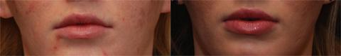 Cosmetic Injectables Before and After Photos in Cincinnati, OH, Patient 5601