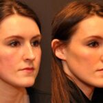 Cosmetic Injectables Before and After Photos in Cincinnati, OH, Patient 5607