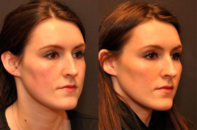 Cosmetic Injectables Before and After Photos in Cincinnati, OH, Patient 5607