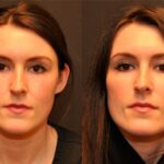 Cosmetic Injectables Before and After Photos in Cincinnati, OH, Patient 5607