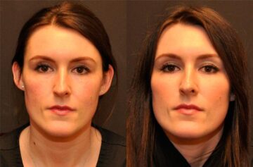 Cosmetic Injectables Before and After Photos in Cincinnati, OH, Patient 5607
