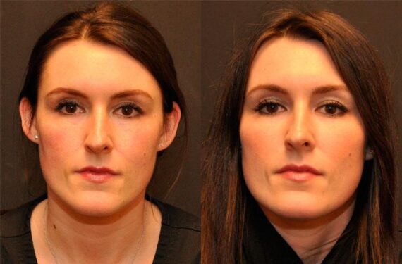 Cosmetic Injectables Before and After Photos in Cincinnati, OH, Patient 5607