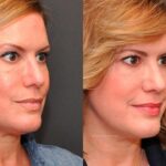 Cosmetic Injectables Before and After Photos in Cincinnati, OH, Patient 5617