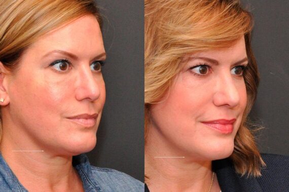 Cosmetic Injectables Before and After Photos in Cincinnati, OH, Patient 5617