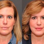 Cosmetic Injectables Before and After Photos in Cincinnati, OH, Patient 5617