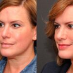 Cosmetic Injectables Before and After Photos in Cincinnati, OH, Patient 5617