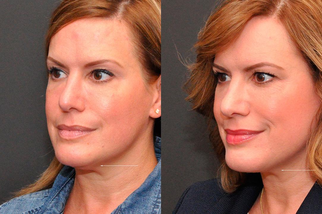Cosmetic Injectables Before and After Photos in Cincinnati, OH, Patient 5617