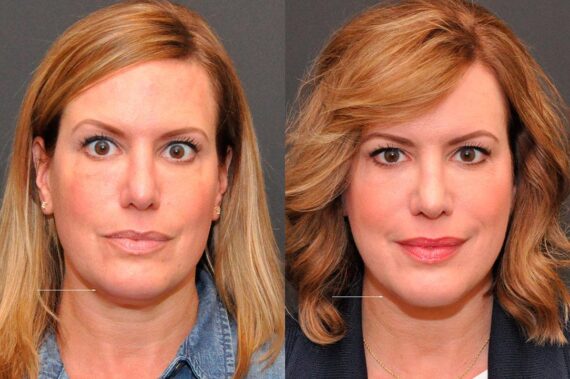 Cosmetic Injectables Before and After Photos in Cincinnati, OH, Patient 5617