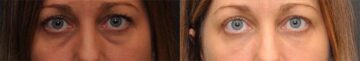 Cosmetic Injectables Before and After Photos in Cincinnati, OH, Patient 5624
