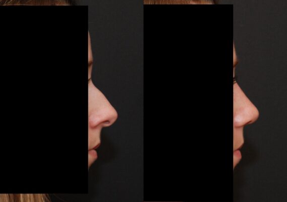 Rhinoplasty (Nose Reshaping) Before and After Photos in Cincinnati, OH, Patient 6194