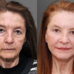 Blepharoplasty Before and After Photos in Cincinnati, OH, Patient 7421