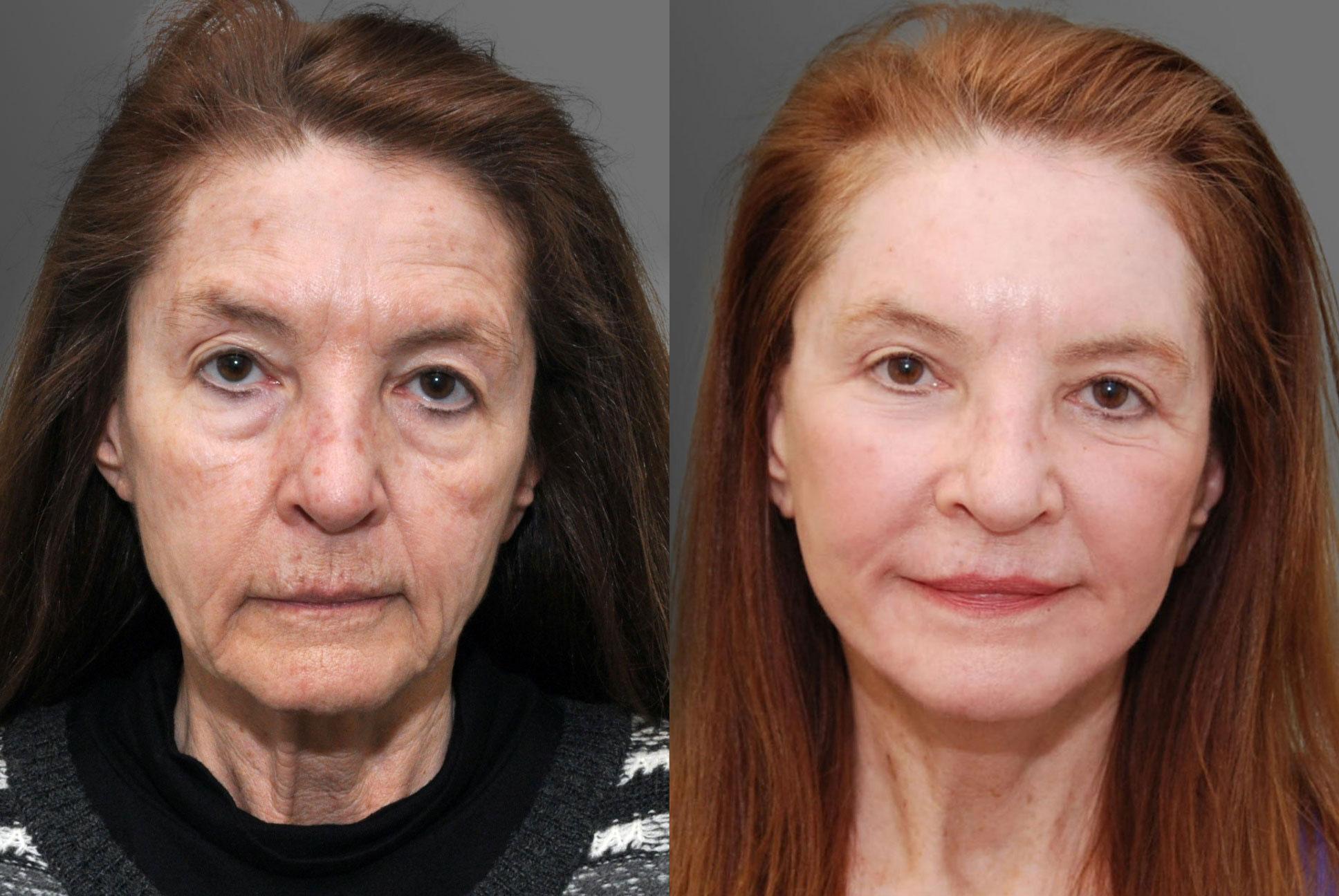 Facial Resurfacing Photos Cincinnati Oh Patient 6085 