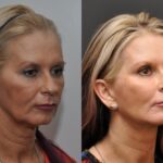 Facial Resurfacing Before and After Photos in Cincinnati, OH, Patient 5888