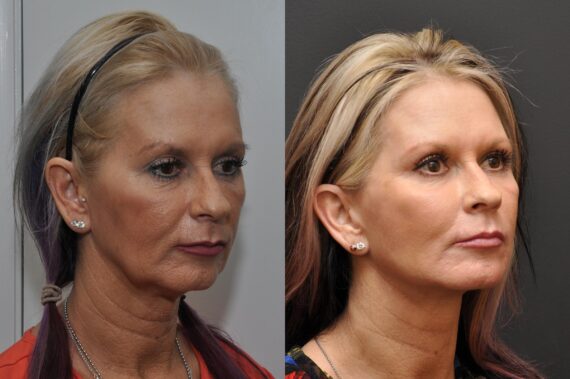 Facial Resurfacing Before and After Photos in Cincinnati, OH, Patient 5888
