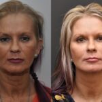 Facial Resurfacing Before and After Photos in Cincinnati, OH, Patient 5888