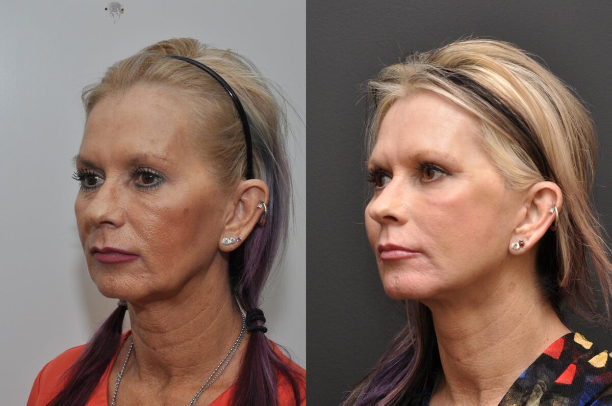 Facial Resurfacing Before and After Photos in Cincinnati, OH, Patient 5888