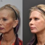 Facial Resurfacing Before and After Photos in Cincinnati, OH, Patient 5888