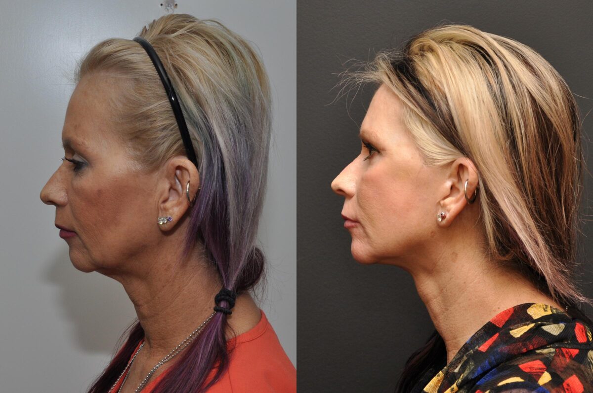 Facial Resurfacing Before and After Photos in Cincinnati, OH, Patient 5888