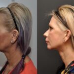 Facial Resurfacing Before and After Photos in Cincinnati, OH, Patient 5888