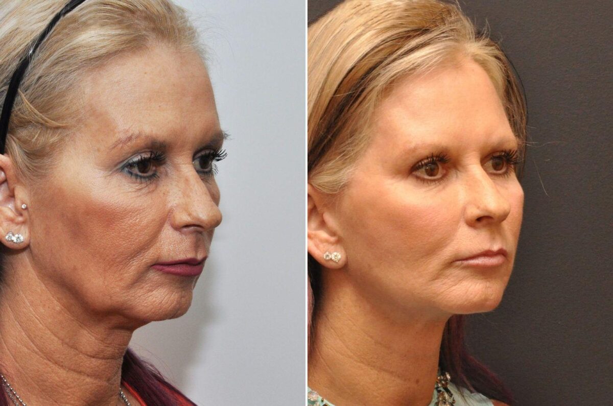 Blepharoplasty Before and After Photos in Cincinnati, OH, Patient 7009