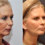 Blepharoplasty Before and After Photos in Cincinnati, OH, Patient 7009